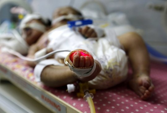 В Йемене родился двухголовый ребенок 